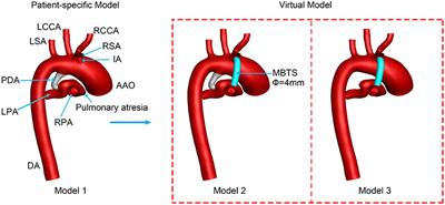 Effects of Patent Ductus Arteriosus on the Hemodynamics of Modified Blalock–Taussig Shunt Based on Patient-Specific Simulation